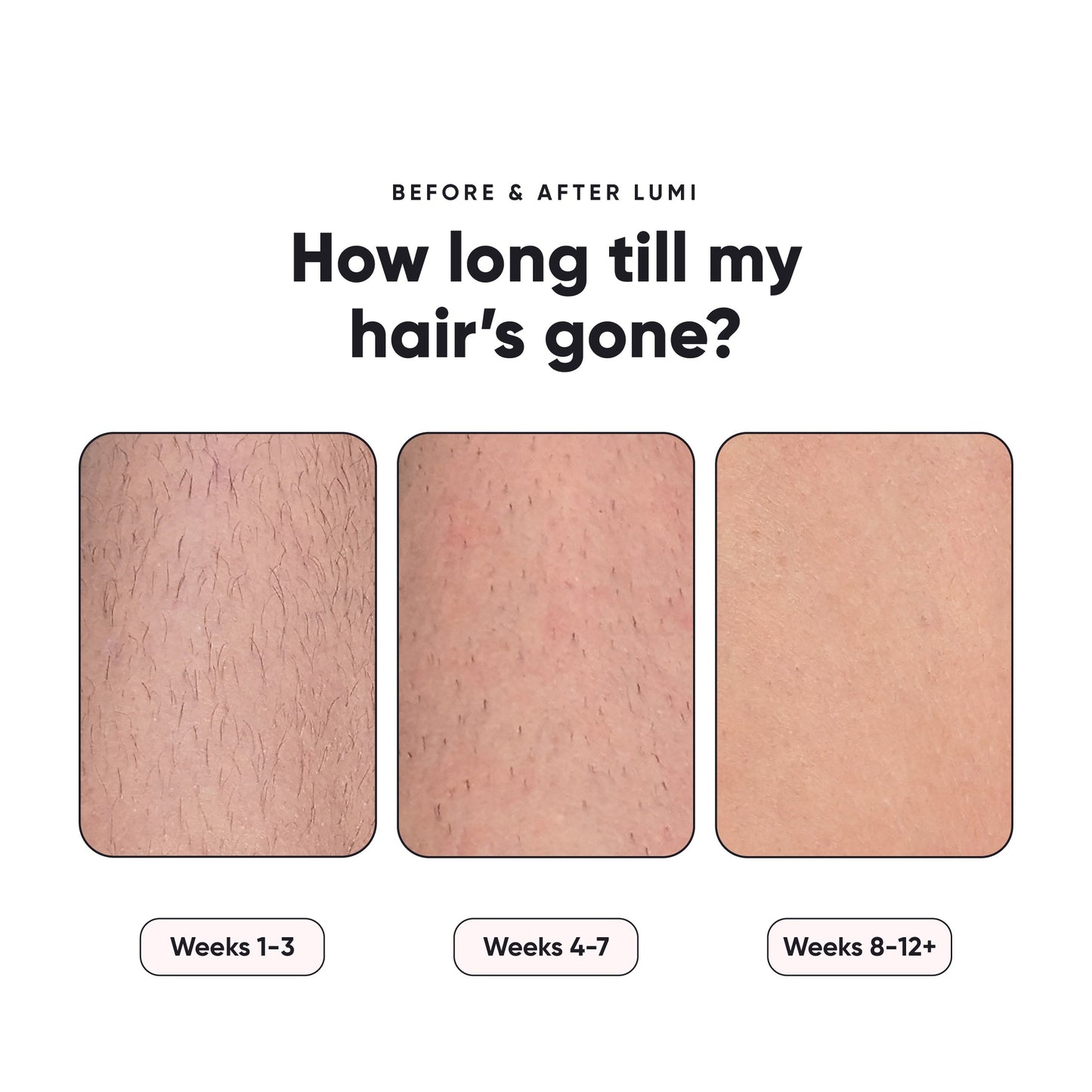 Lumi 1 - Permanent Hair Removal Device