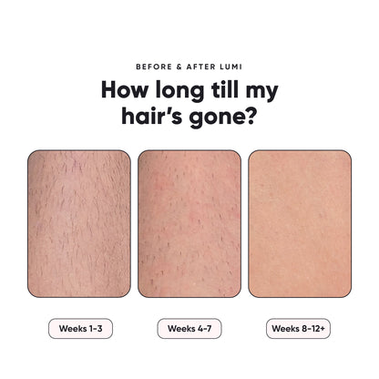 Lumi 1 - Permanent Hair Removal Device